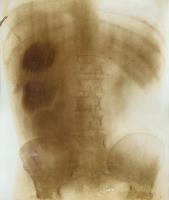 Prof. Contremoulin (attributed to) - Large X-Ray of a Torso